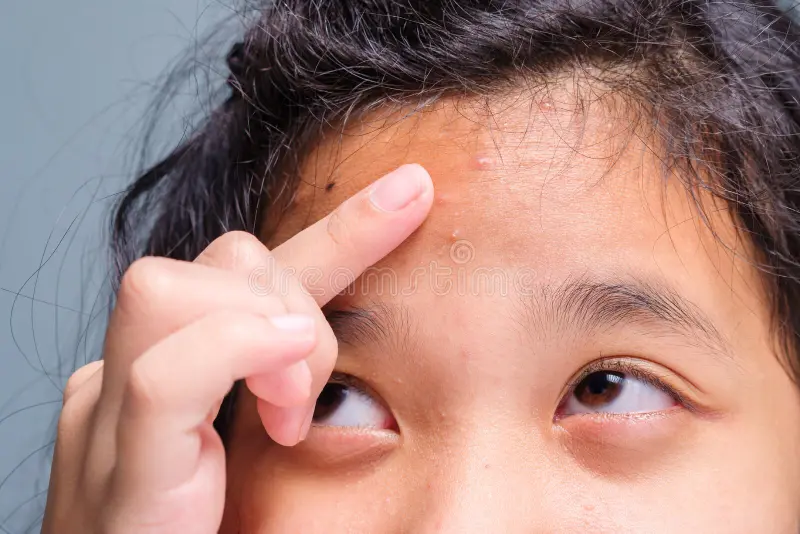 First Time Acne: Gimana Cara Ngadepin Jerawat Pertama Kali?